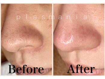 トータルビューティー ミミ(Total Beauty mimi)/毛穴詰まりもスッキリ！