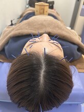 まえかわ鍼灸整骨院/美容鍼＋温灸