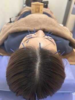 まえかわ鍼灸整骨院/美容鍼＋温灸