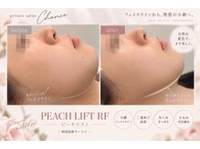 シャンス(Chance)の雰囲気(症例 )