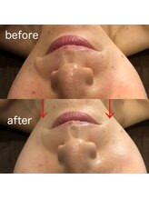 ディースズ(D.suzu)/白玉リフティングbefore/after