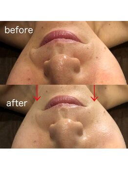 ディースズ(D.suzu)/白玉リフティングbefore/after