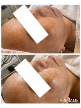 ジュエッテ(jouete)/圧倒的人気！水光白玉肌管理