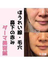 みき接骨院/姫路初ダーマ美容鍼＋ヒト幹細胞