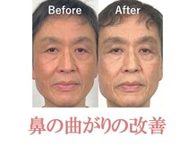 ラプリ 銀座店(Raplit)/隆鼻＋輪郭矯正40分10回