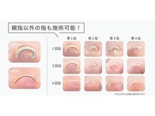 ジュートネイル(jute nail)の雰囲気（フットネイルのオプションで巻き爪矯正も追加できます◎）