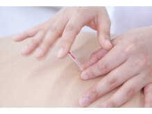 ムーン(Moon)の雰囲気（ベテラン女性スタッフによる鍼施術で腰痛や肩こりを改善！）