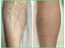 クリア 尾張旭店(Clear)/【Clear脱毛ビフォーアフター】