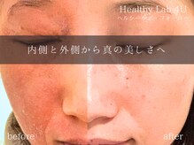 ヘルスラボフォーユー(Health Labo4U)/乾燥肌や肌荒れ改善にも