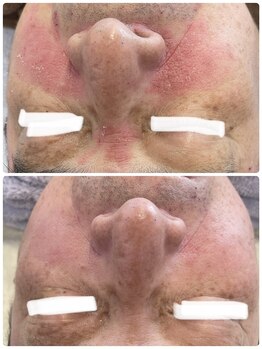 クラティス(CRATIS)/酒さ、赤ら顔