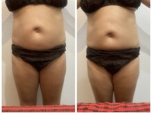 マハロ スコータイ/ビフォーアフター　＜お腹＞