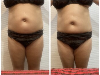 マハロ スコータイ/ビフォーアフター　＜お腹＞