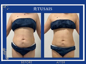 ビテュセスリー はなみずき店(美tusais3)/【痩身・ダイエット】ボディケア