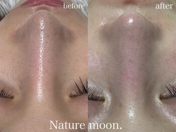 ナチュールムーン(Nature moon.)/毛穴洗浄