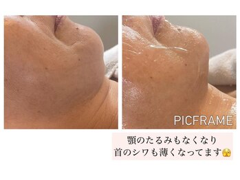 ジュエッテ(jouete)/大人気！たるみ管理