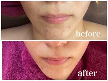 ルー ハナレ 神戸岡本 摂津本山店(Luu HANARE)/フェイスライン小顔・毛穴　4回