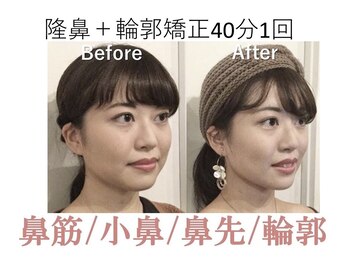 ラプリ 大阪心斎橋店(Raplit)/隆鼻＋輪郭矯正40分10回