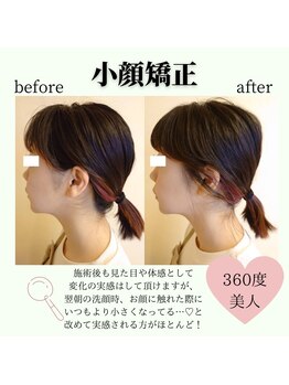 RKY/小顔矯正&頭蓋骨矯正で横顔美人