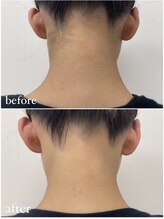 ローズ(Rose)/脱毛