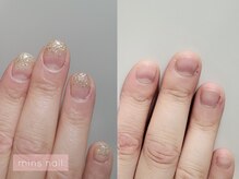 ミンスネイル(Mins Nail)/深爪矯正before&after