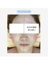 ジール(GIILL)/フェイシャルビフォーアフター