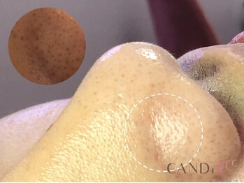 キャンディ 大阪梅田店(CANDi)/ハイドラピーリング/黒ずみ毛穴