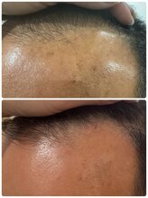 マニス(manis)/ヒト幹細胞培養液