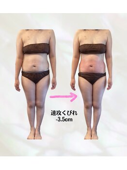 カリス(charis)/一度に施術で3.5cm減