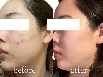 エトワール 駒沢大学駅前店(ETOILE)/肌質改善|ニキビ・毛穴ケア