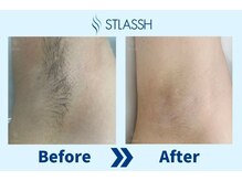 ストラッシュ 仙台店(STLASSH)/【ストラッシュ】お客様の施術例