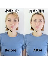 リバイブ 五反田店(REVIVE)/5回でエラはり解消