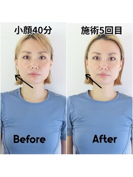 リバイブ 五反田店(REVIVE)/5回でエラはり解消