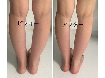 メディカルエステ ユウ(Yuu)/症例写真/痩身/足のむくみ/1回目