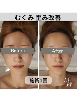 ミピマム/小顔コルギ