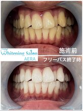 アエラ(AERA)/【フリーパスコース比較写真】