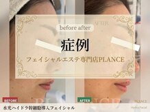 プランス 渋谷(PLANCE)/渋谷エステ/ニキビケア