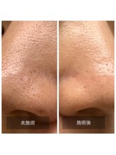 メディスキン ザ 銀座(MEDISKIN)/毛穴ハイドロピーリング