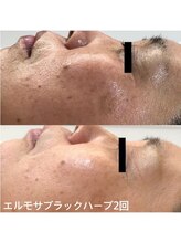コトハ(cottha)/エルモサハーブピーリング