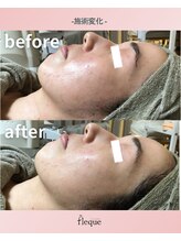 フレク(fleque)/ハーブピーリング施術直後