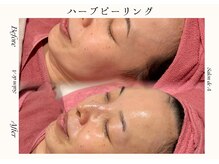 サロンドエー 帝塚山(Salon de A)/ハーブピーリング