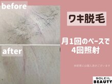 ソレイユビューティー 愛知大学前(SOLEIL BEAUTY)/ワキ脱毛