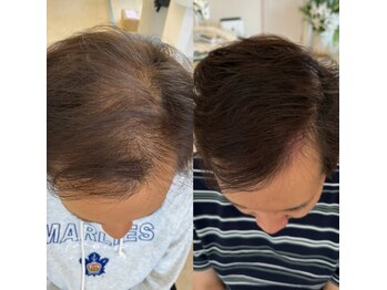 グラッシー(glassea)/プロセル頭皮トリートメント