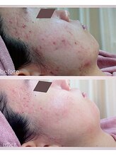 クリニカルエステクリア 梅田店/【お客様のBefore→After】