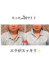 顔凛(カオリン)/30代/エラがスッキリ小顔矯正