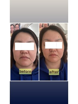 リリースパ 辻堂店(Lily spa)/浮腫/シミ/シワ/毛穴/ニキビ改善