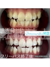 ホワイトニングサロン 名古屋 栄店/【ホワイトニング】