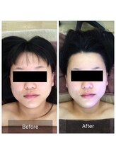 リセット 宇都宮店(R'eset)/1番人気☆小顔矯正