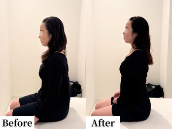 ソレア(Solea)/肩こり・巻き肩改善1回目