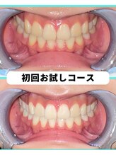 ホワイトニングビューティー 吉祥寺店/ホワイトニング　初来店