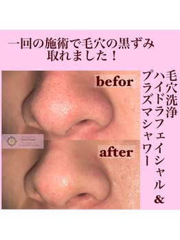 ジュエルボンド(Jewel Bond)/【毛穴洗浄ハイドラ】